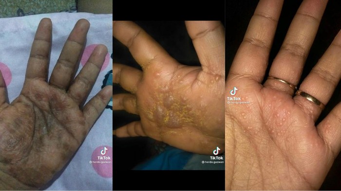 Viral Curhat Wanita Gagal Jadi Cantik Gegara Tangan Bernanah, Ini Ceritanya
