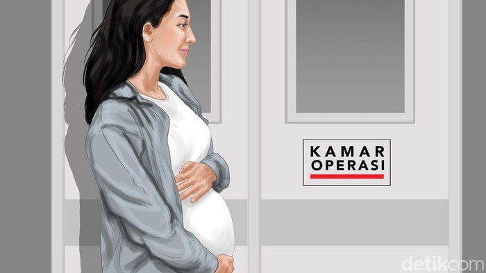 Ilustrasi ibu hamil memilih metode persalinan.