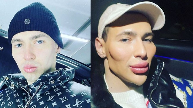 Seorang mantan tentara Rusia bernama Kirill Tereshin sempat bikin heboh karena melakukan pembesaran otot dengan cara yang tidak sehat. Ia menyuntikkan tiga liter petroleum jelly agar tangannya kekar bak Popeye. Kini Kiril memiliki obsesi baru yakni ingin bertransformasi jadi alien.Foto: Instagram @ kirilltereshin96