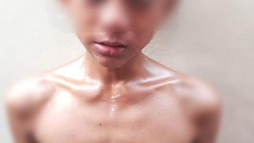 Bocah korban kekerasan tetangga di Bima, NTB