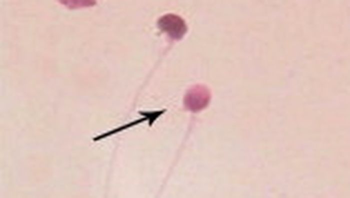 Sperma ini memiliki abnormalitas kepala yang terlalu bulat. (Foto: Middle East Fertility Society Journal/Sohair A. Abd El-baset)