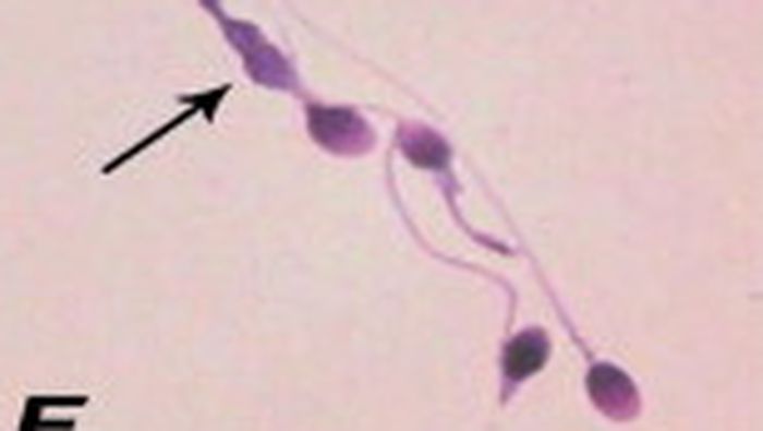 Bagian tengah ekor sperma memiliki abnormalitas terlalu tebal. (Foto: Middle East Fertility Society Journal/Sohair A. Abd El-baset)