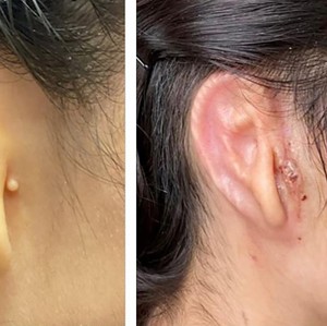 Wanita Ini Jadi Orang Pertama yang Dapat Transplantasi Telinga 3D