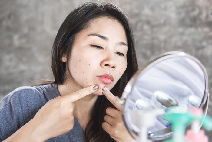 Asian woman having skin problem with acne face ,squeezing pimples with mirror