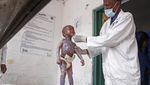 Foto Ini Tunjukkan Penderitaan Anak-anak Somalia yang Kena Gizi Buruk