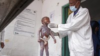Dilaporkan setidaknya 448 orang meninggal di pusat perawatan malnutrisi rawat jalan dan rawat inap di seluruh Somalia tahun ini.