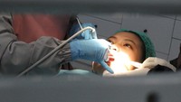 Cara Bersihkan Karang Gigi Pakai BPJS Kesehatan, Gratis