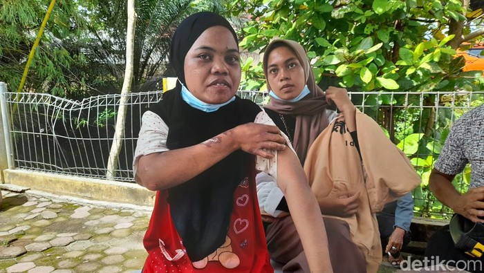ART korban penyiksaan oleh majikan.