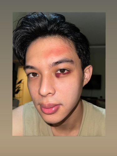 Kondisi mata Rey Mbayang