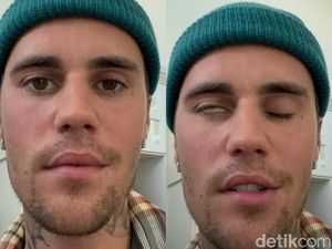Justin Bieber Terkena Ramsay Hunt Syndrome, Ini Penjelasan Pakar Unair