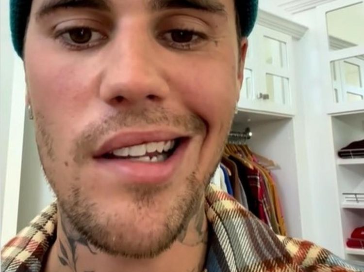 Kondisi Wajah Justin Bieber yang Idap Ramsay Hunt Syndrome