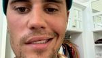 Kondisi Wajah Justin Bieber yang Idap Ramsay Hunt Syndrome