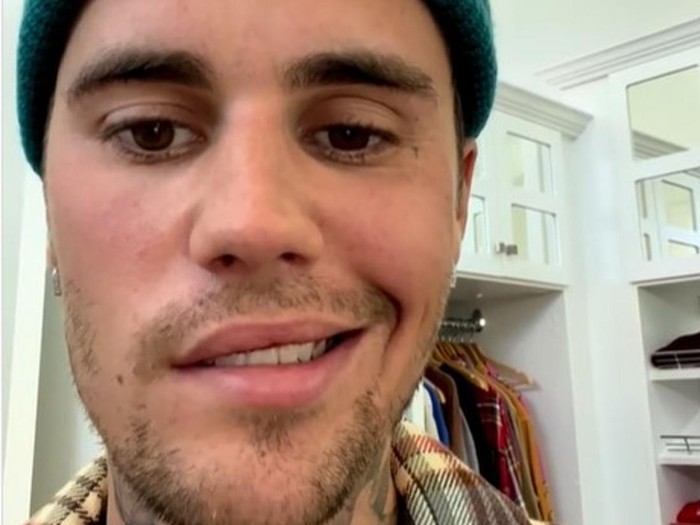 Justin Bieber idap Ramsay Hunt Syndrome