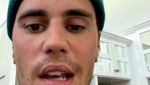 Kondisi Wajah Justin Bieber yang Idap Ramsay Hunt Syndrome