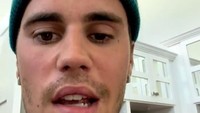 Ramsay Hunt Syndrome diketahui merupakan komplikasi herpes zoster yang terjadi ketika wabah berdampak pada saraf wajah di dekat satu telinga.  Foto: dok ist