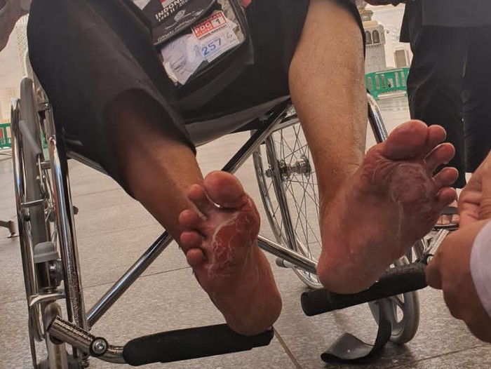Jemaah haji asal Tuban nekat berjalan tanpa alas kaki di bawah terik sekitar 50 derajat celsius. Dampaknya, telapak kakinya melepuh.