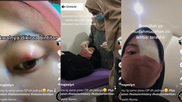 Viral TikTok Wanita Depok mengeluhkan gejala bintitan tak kunjung sembuh.