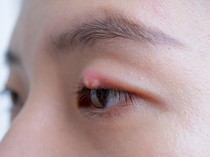 Terlalu Sering Makan Telur Bisa Bikin Bintitan, Mitos atau Fakta?