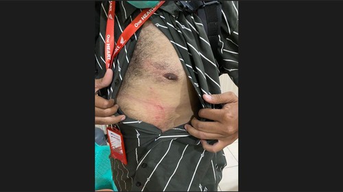 korban memperlihatkan luka yang dialaminya usai mengalami insiden tabrak lari