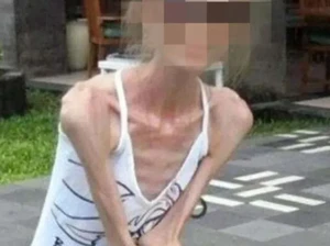 Ngeri! Wanita Ini Terobsesi Kurus, Berat Badannya Hanya 25 Kg