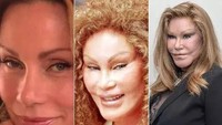 Jocelyn Wildenstein. Wanita kaya ini rela menghabiskan jutaan dolar untuk operasi plastik yang malah bikin terlihat aneh. Lihat saja perubahan wajahnya. Dok. The Mirror via Scoopwhoop.