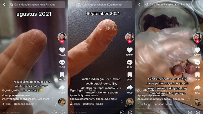 Viral jari wanita Bandung melepuh Viral jari wanita Bandung melepuh, dikira kutu air biasa,
