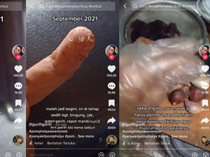 Viral Curhat Jari Wanita Bandung Melepuh-Sidik Jari Hilang, Gegara Bawang?