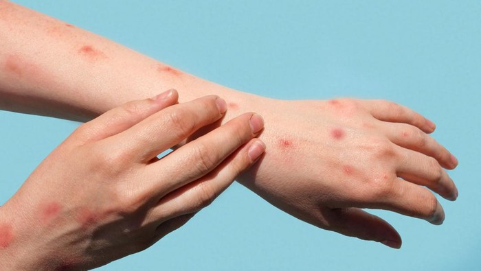 Monkeypox new disease dangerous over the world. Patient with Monkey Pox. Painful rash, red spots blisters on the hand. Close up rash, human hands with Health problem. Banner, copy space. Painful rash, red spots blisters on the hand. Close up Allergy rash, human hands with dermatitis and Health problem. Ill eczema skin of patient. Viral Diseases. Red rashes on the palm. Enterovirus. coxsackie