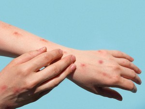 Wabah Mpox Jadi Darurat Kesehatan Global, Ini Gejala yang Harus Diwaspadai