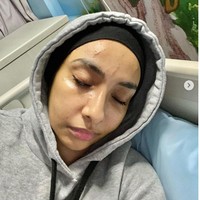 Pada Selasa (28/6/2022), Lufya Omar membuat unggahan yang menghebohkan netizen. Dia memamerkan wajahnya yang luka-luka. Foto: Dok. Instagram @lufyalaana