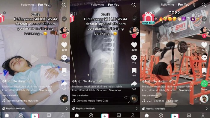 Viral TikTok skoliosis Viral wanita asal Cimahi, Bandung, mengidap skoliosis 44 derajat hingga akhirnya berhasil sembuh.