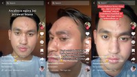 Cerita di Balik Viral Pria Jakarta Kena Herpes Zoster, Sempat Dikira Jerawat Biasa