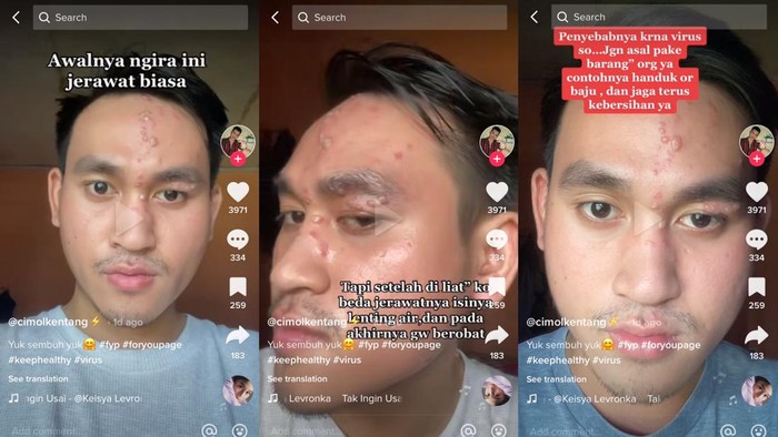 Viral TikTok Seorang pria terkena herpes zoster, mulanya mengira jerawat biasa.
