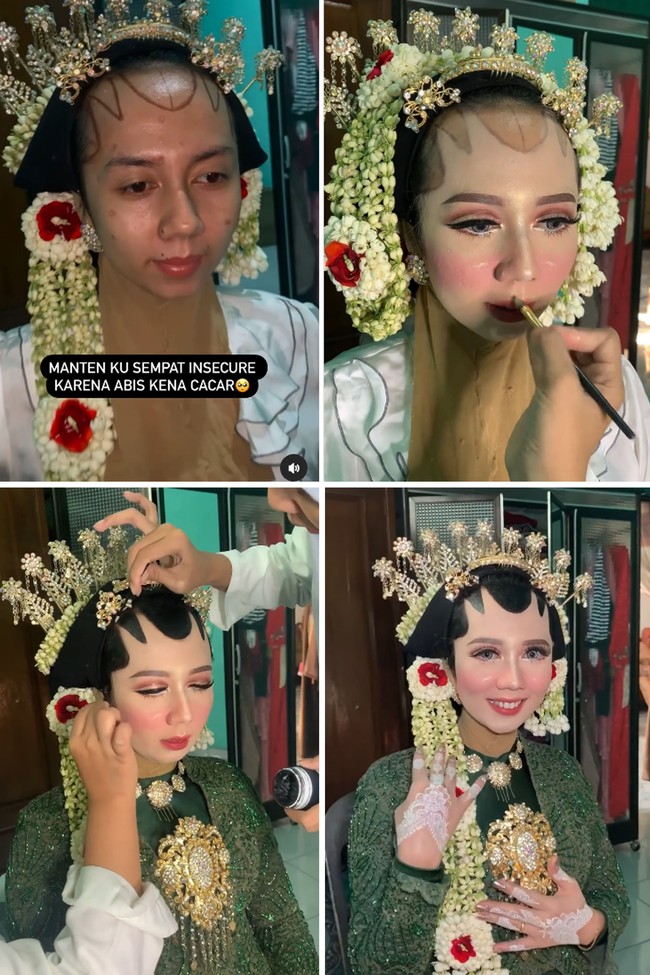 Acara pernikahan pengantin wanita itu digelar pada 26 Juli 2022 di Batanghari, Lampung Timur, Bandar Lampung. Elin mengungkapkan saat melihat kondisi wajah kliennya dan menjelaskan penanganannya. Reaksi awal lumayan tegang, pengantin aku ajak ngobrol dulu biar relax dan nggak insecure. Seperti yang sudah-sudah hampir sama sebenarnya dengan noda jerawat cara mengatasi nya. Hanya menggunakan foundie yang lumayan bisa cover noda-noda. Dan aku up warna tone foundie nya karena di kampung memang suka yang putih-putih bikin mangling, ucap MUA yang berusia 37 tahun itu. Foto: Dok. Instagram @elinnherlin_.