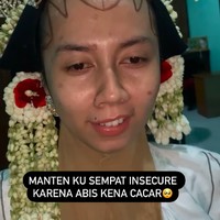 Wanita ini merasa kurang percaya diri alias insecure karena memiliki bekas cacar di wajahnya. Kepercayaan dirinya langsung luntur setelah melihat transformasi makeupnya sebagai pengantin yang bikin terkejut. Kisah pengantin wanita dengan bekas cacar di wajah itu viral setelah dibagikan oleh akun TikTok @elin.afiat. Dalam unggahannya, dia memperlihatkan perubahan wajah sebelum dan sesudah makeup. Pengantin ku sempat insecure karena noda cacar, tulis akun TikTok @elin.afiat. Foto: Dok. Instagram @elinnherlin_.