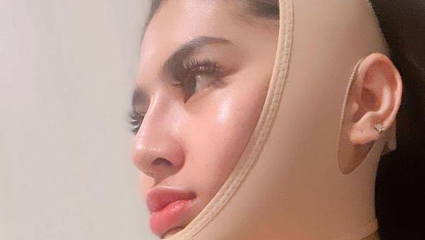 Iqlima Kim sedot lemak di pipi.