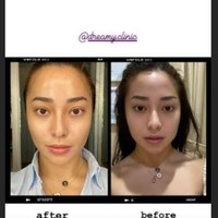 Nikita Willy juga terang-terangan menyebut bahwa dirinya melakukan perawatan botox. Pada 2020 lalu, dia memperlihatkan wajahnya before after botox. Biasanya kalau aku ngaca, mukaku terlihat kotak, tapi sekarang lebih seperti huruf V shape-nya. Terus nggak terasa sakit juga, pokoknya it’s all good. Setelah ini aku mau tunjukkin juga bentuk wajah aku before dan after botox, ucapnya.Foto: dok. Instagram
