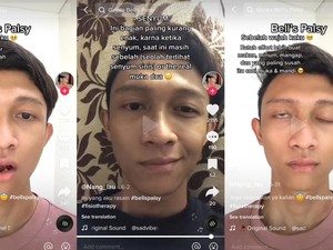 Fakta-fakta Pria Tangerang Kena Bells Palsy, Disebut Gegara Sering Kena AC