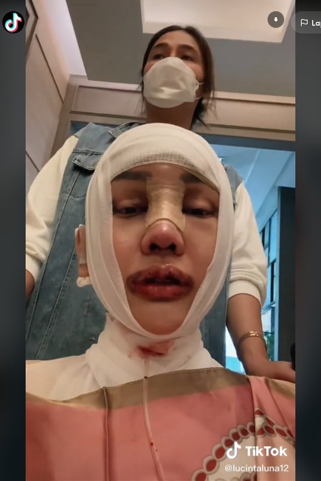 Bukan tanpa risiko, seperti yang diungkap Lucinta Luna, opeasi itu bisa menimbulkan efek samping, seperti kesulitan menelan. Biasanya juga terjadi pembengkakan, perasaan nyeri, dan melemahnya suara.  Foto: TikTok @lucintaluna12