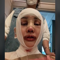 Bukan tanpa risiko, seperti yang diungkap Lucinta Luna, opeasi itu bisa menimbulkan efek samping, seperti kesulitan menelan. Biasanya juga terjadi pembengkakan, perasaan nyeri, dan melemahnya suara.  Foto: TikTok @lucintaluna12