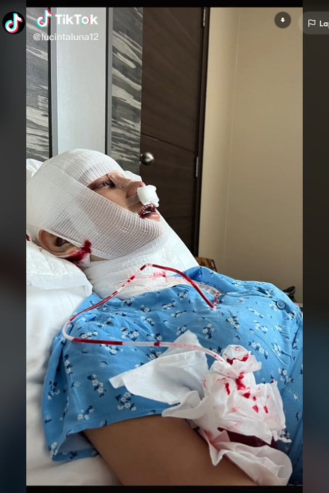 Operasi menghilangkan jakun diketahui cukup mahal dan berisiko. Meski Lucinta Luna mengaku tujuannya adalah untuk menghilangkan suara khodam atau suara beratnya. Tapi umumnya prosedur itu dilakukan untuk mengurangi tampilan atau ukuran jakun. Foto: TikTok @lucintaluna12