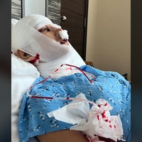 Operasi menghilangkan jakun diketahui cukup mahal dan berisiko. Meski Lucinta Luna mengaku tujuannya adalah untuk menghilangkan suara khodam atau suara beratnya. Tapi umumnya prosedur itu dilakukan untuk mengurangi tampilan atau ukuran jakun. Foto: TikTok @lucintaluna12