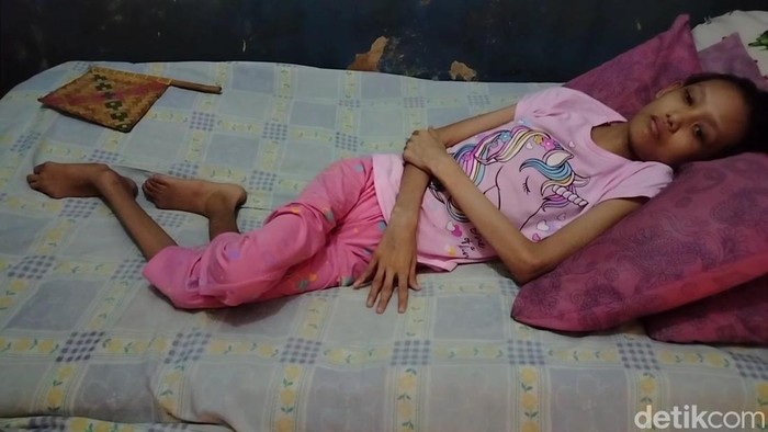 Ayu (25) warga Dusun Jalitri Rt 021/009, Desa Mulyasari, Kecamatan Pamanukan, Kabupaten Subang, Jawa Barat yang tidak bisa berjalan selama 25 tahun.