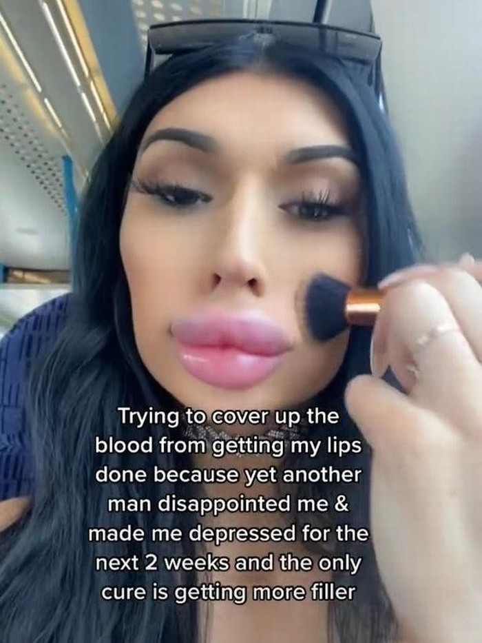 Transgender filler bibir setiap patah hati