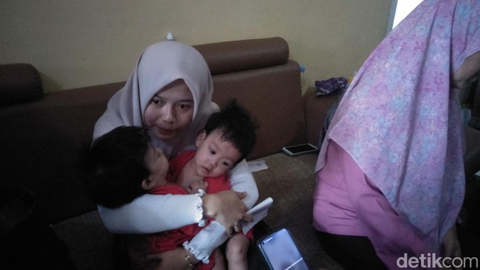 Kondisi bayi kembar siam di KBB