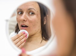 Menurut Dokter, Ini Kandungan Skincare yang Ampuh Atasi Hiperpigmentasi