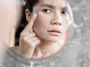 Cara Menghilangkan Flek Hitam di Wajah Secara Alami dan Medis