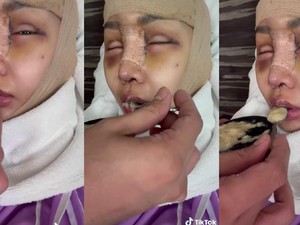 Cerita Lucinta Luna Rahang Belum Menyatu Pasca Digergaji, Masih Susah Nelen