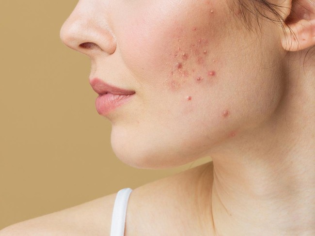 Young woman before and after acne treatment. Skin care concept