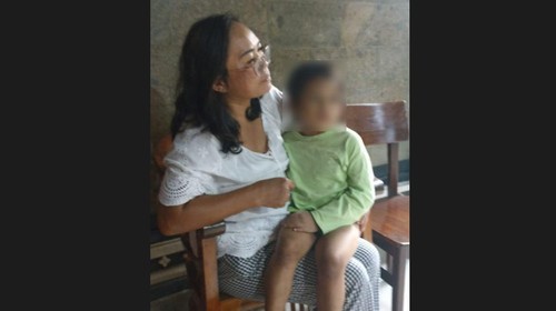 Anak kecil yang mengaku bernama Naya ditemukan telantar dengan luka memar dan kaki patah di Desa Sidakarya, Kecamatan Denpasar Selatan, Kota Denpasar